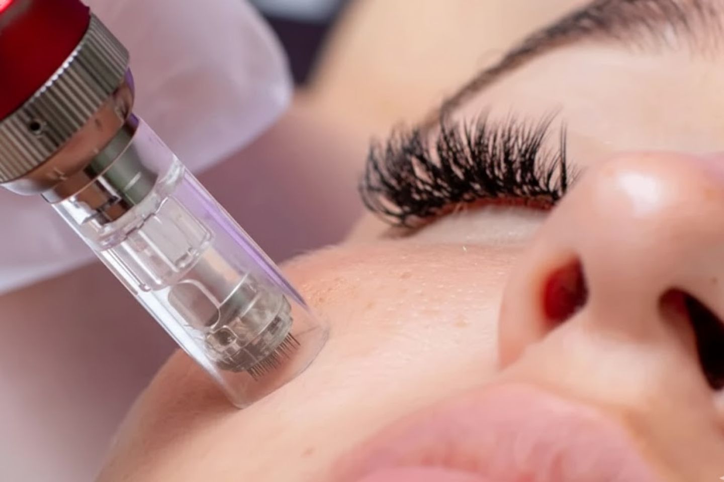 Microneedling en NYC Skin Care Studio para mejorar textura y apariencia de la piel