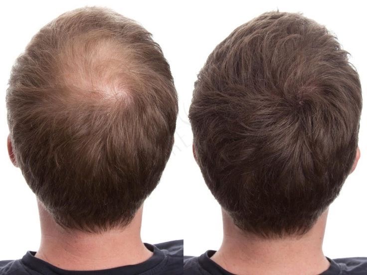 Antes y después: cambio visible en densidad y apariencia del cabello