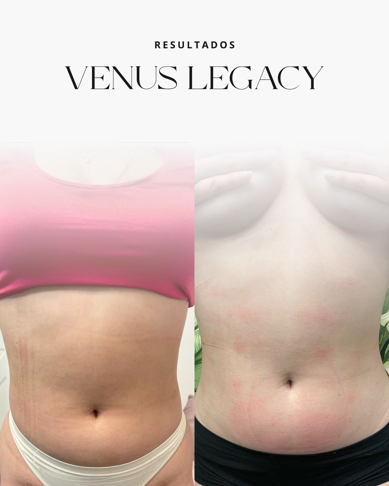 Venus Legacy treatment at NYC Skin Care Studio