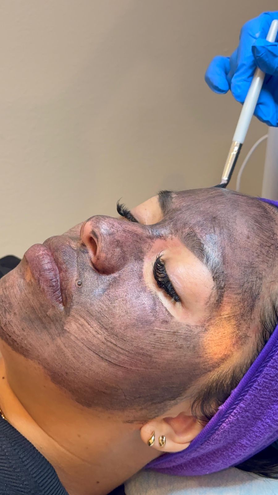 Activated charcoal mask on the face before the laser pass