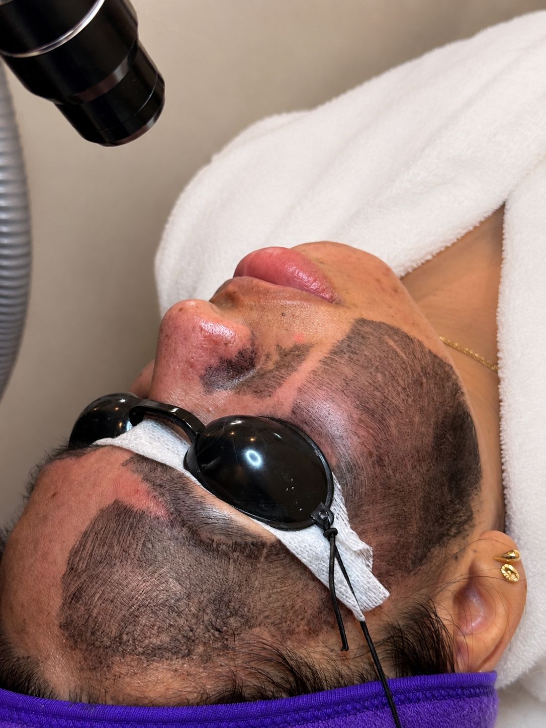Carbon Laser Peel session with eye protection in New York
