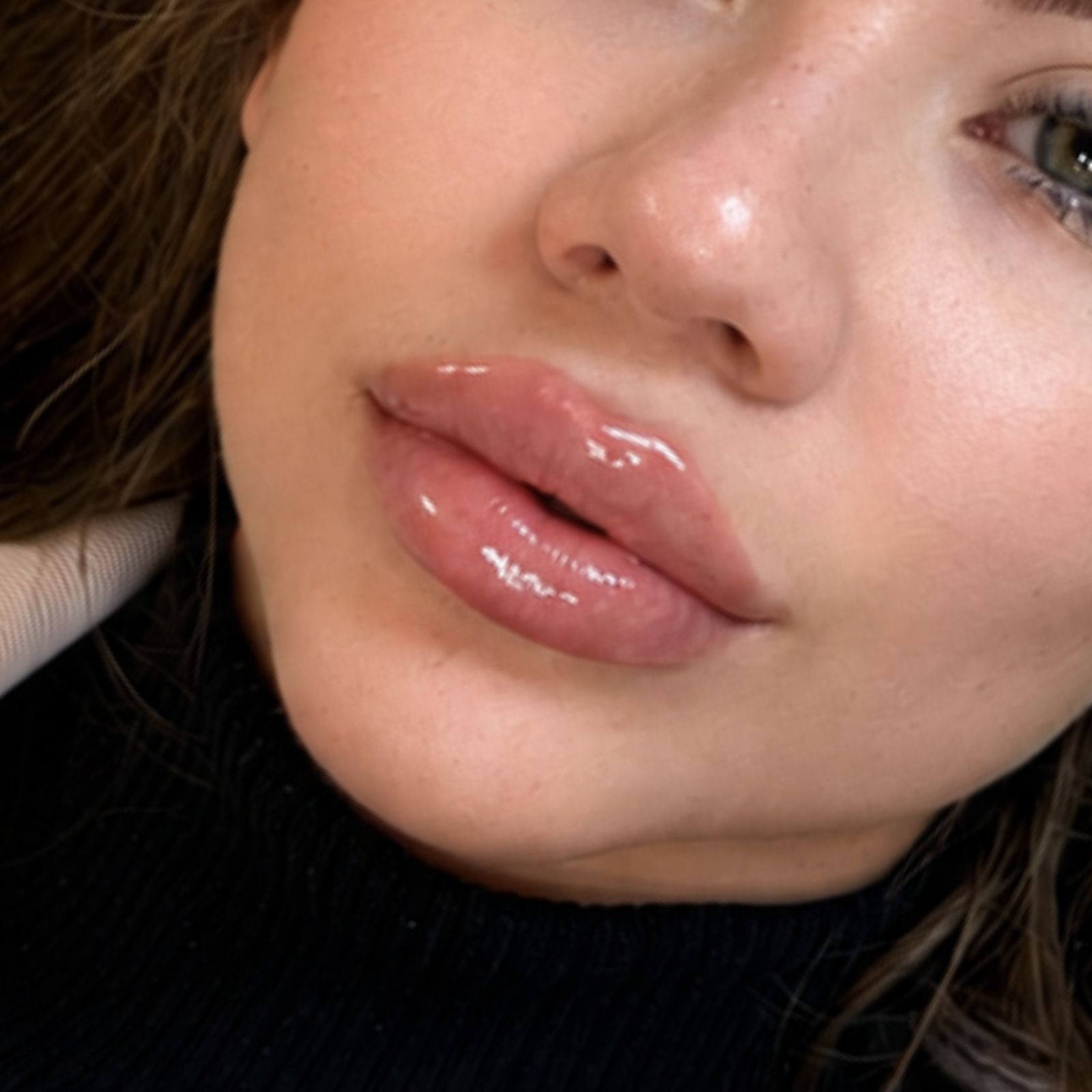 Hyaluronic acid lip filler application in New York