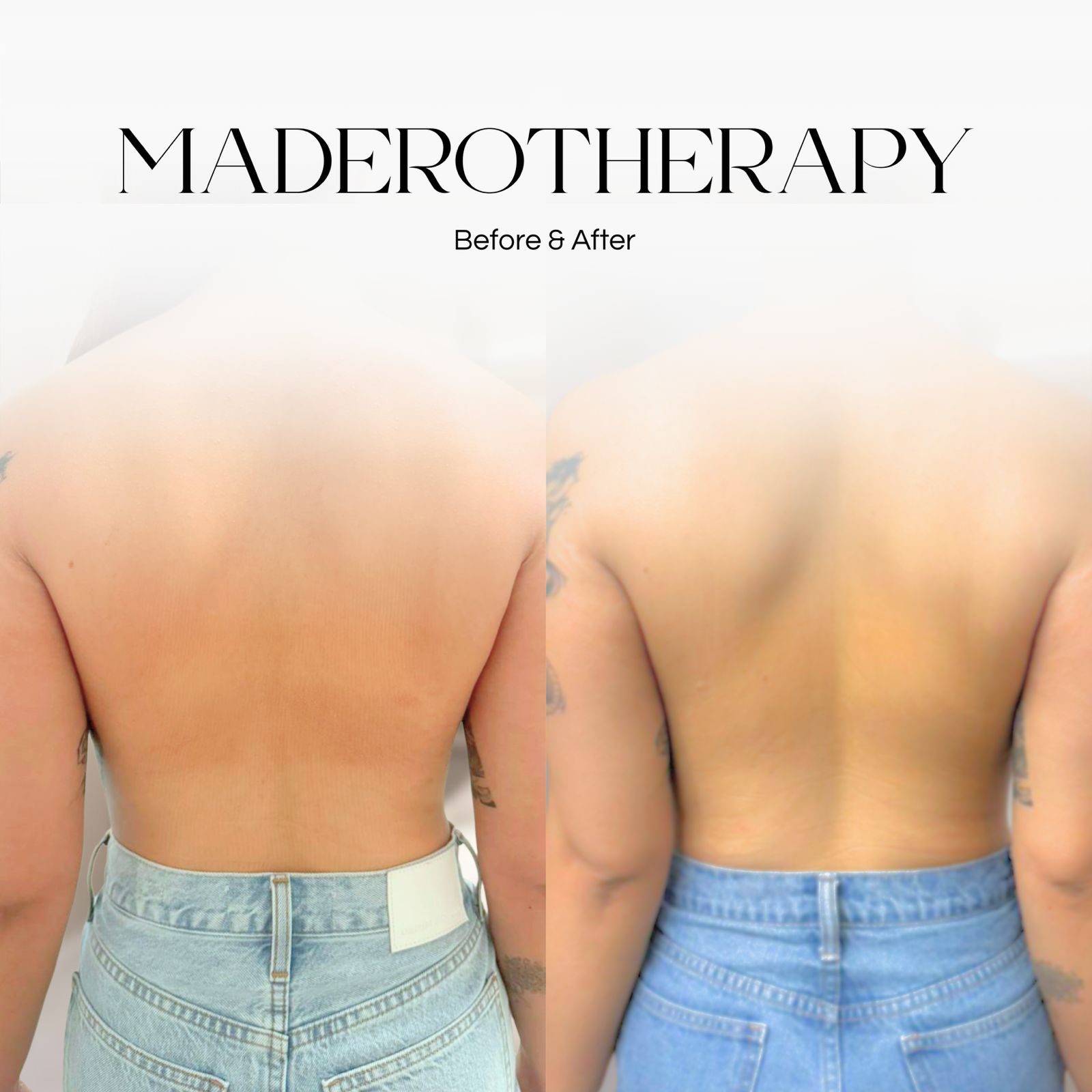 Maderotherapy body treatment at NYC Skin Care Studio